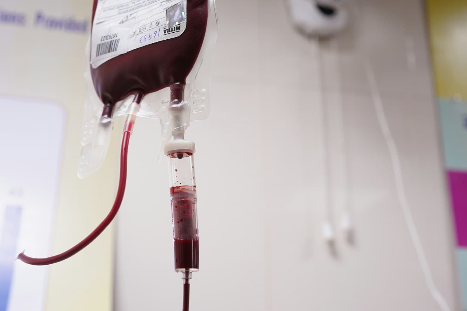 A bag of donated blood hanging on a line above a drip chamber during a transfusion.