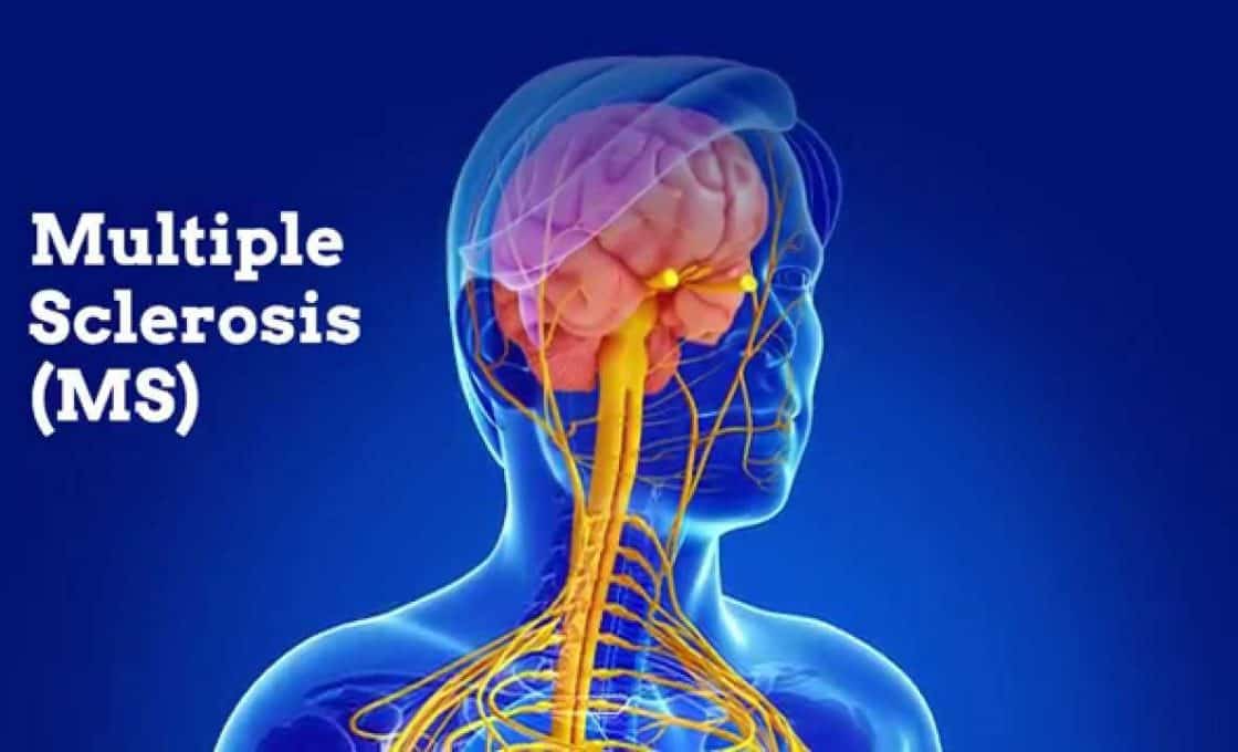 Brain and nervous system illustration for fenebrutinib BTK inhibitor Phase 3 clinical trial results in multiple sclerosis