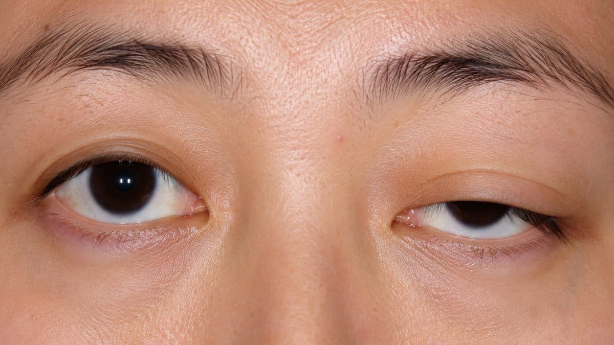 A close-up photograph of a person's face showing asymmetric ptosis, with the right eyelid drooping noticeably while the left eye is fully open, illustrating the classic ocular sign of generalized myasthenia gravis that Rystiggo (rozanolixizumab) is approved to treat in anti-AChR or anti-MuSK antibody-positive adults