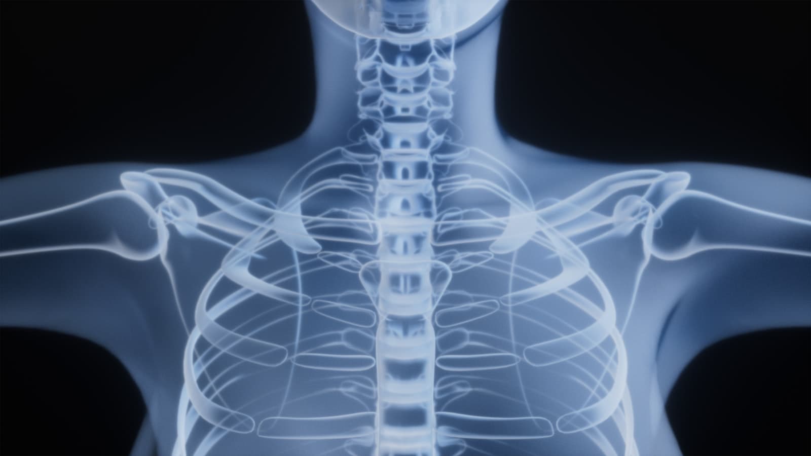 X-ray of a human torso and shoulders, the kind of imaging used to track new bone growth in FOP.